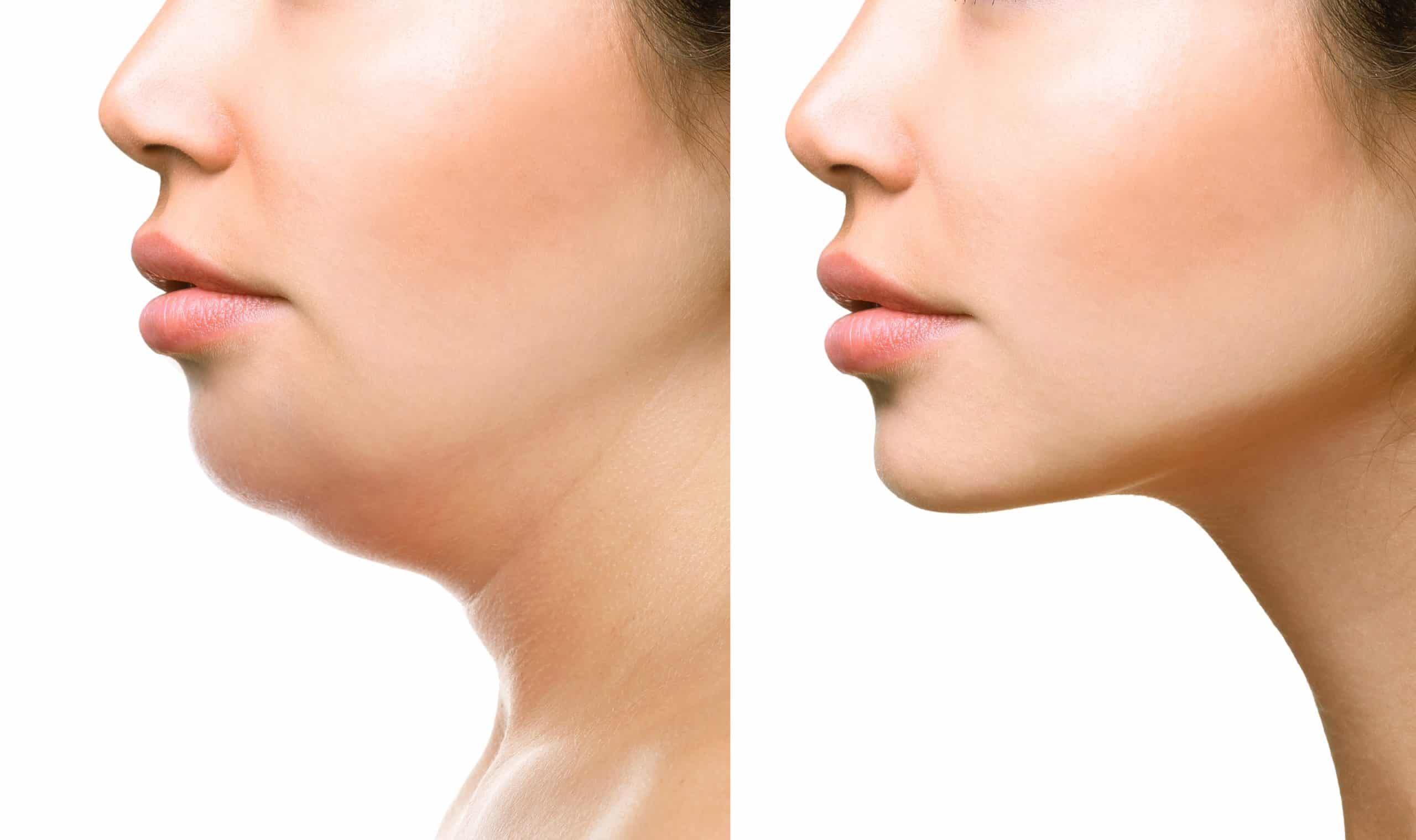 Double Chin Liposuction