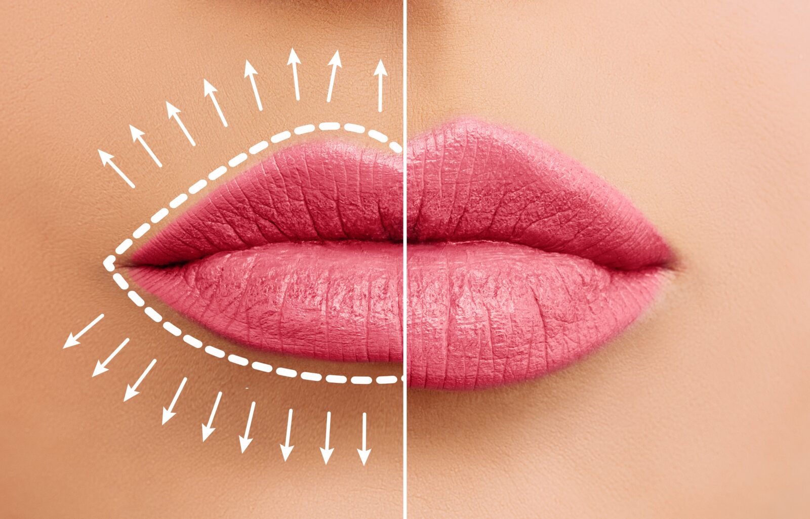Lip Filler