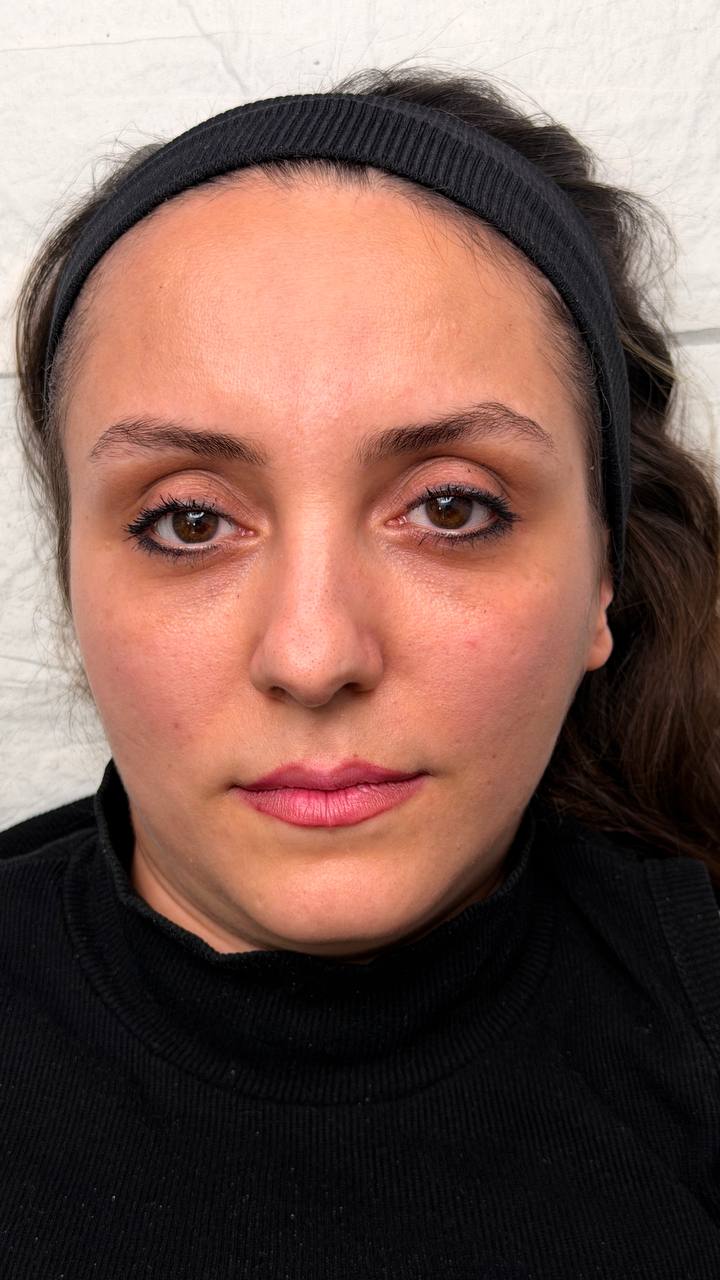 before procedure