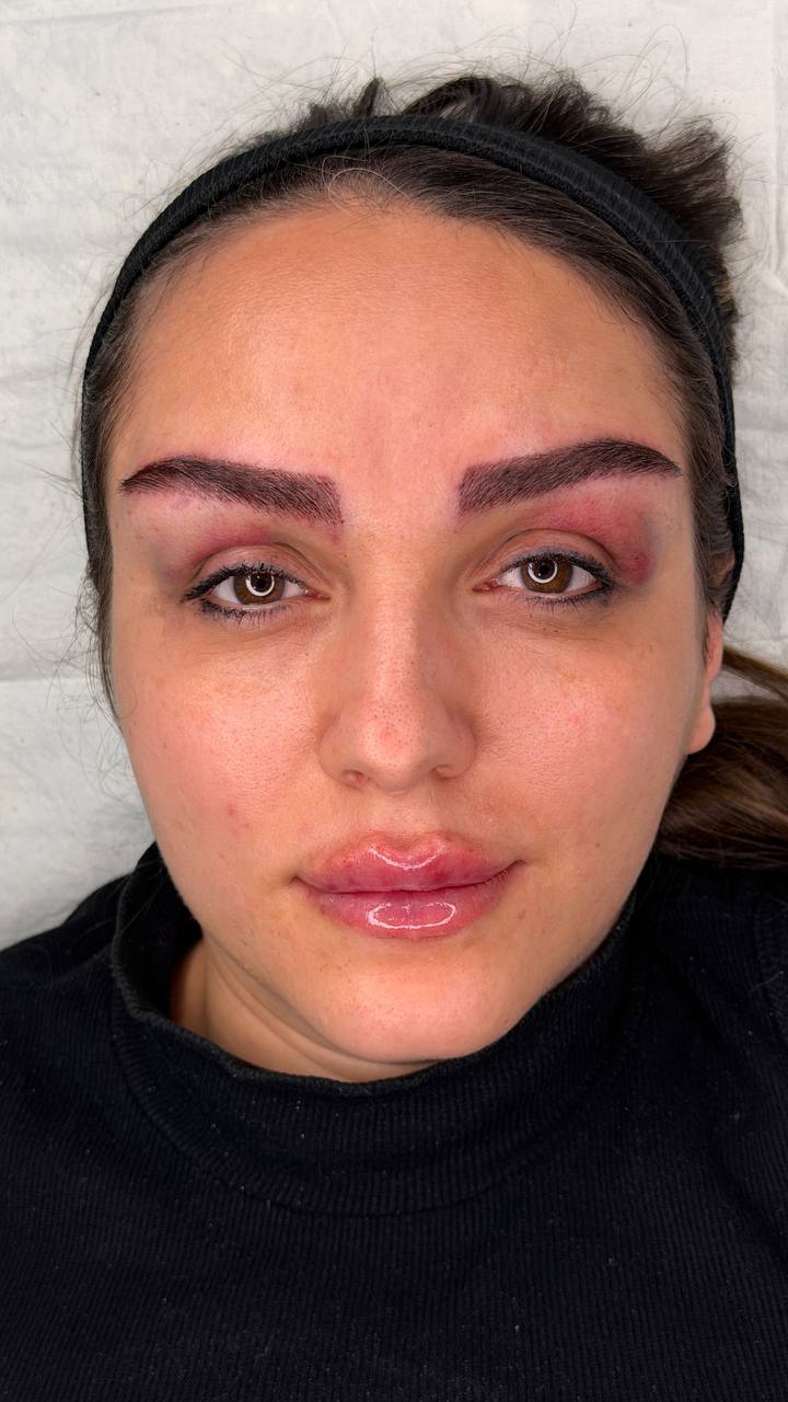After procedure