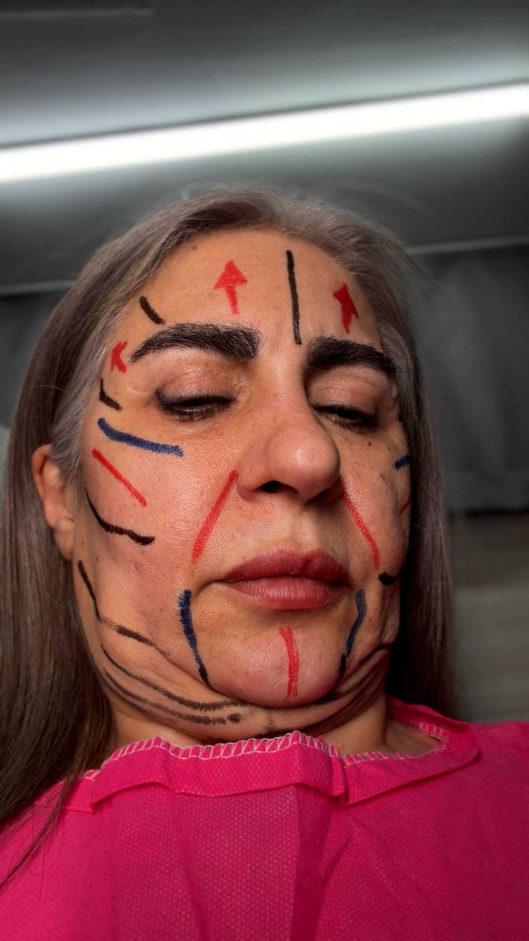 before procedure