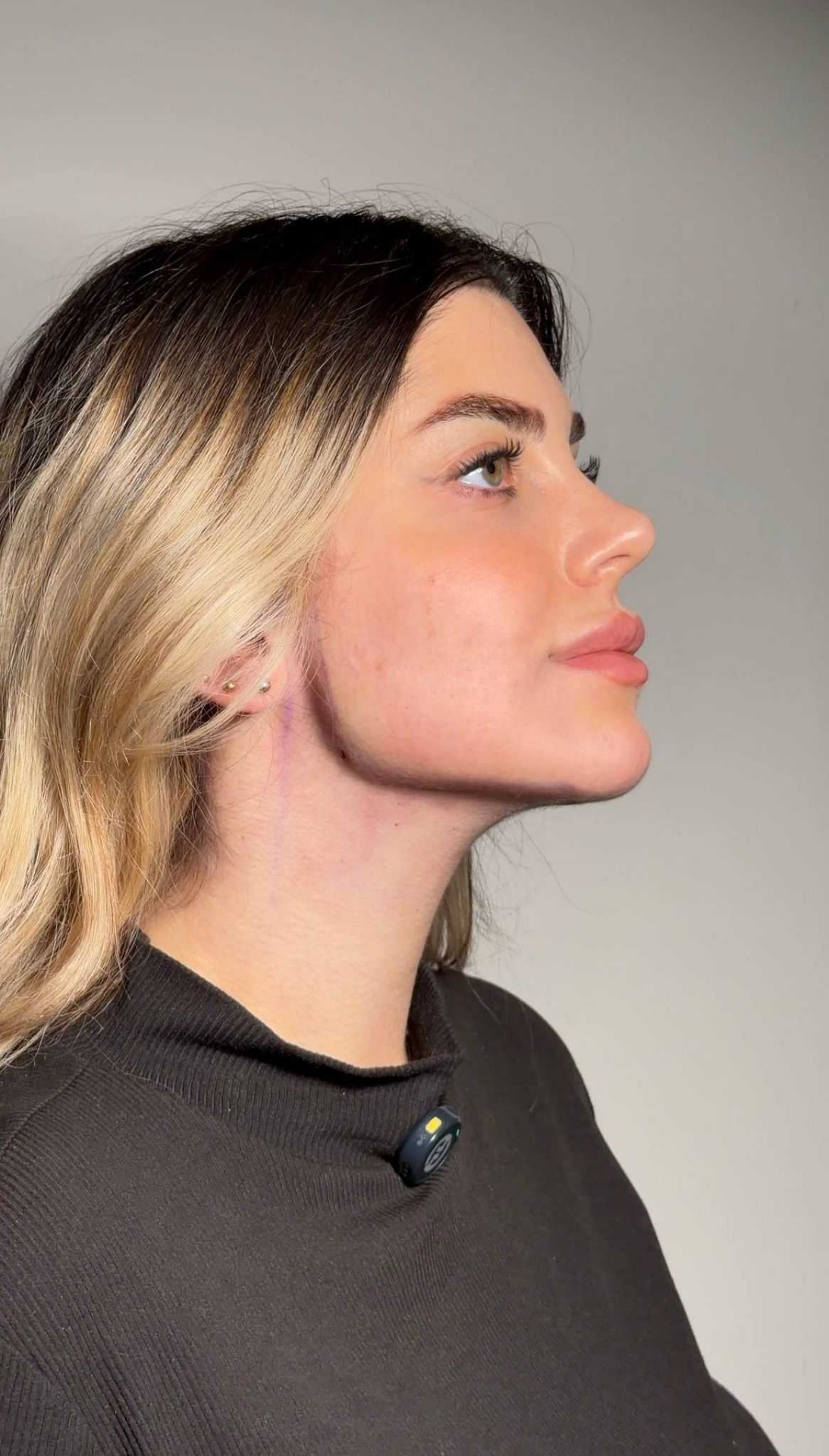 after procedure