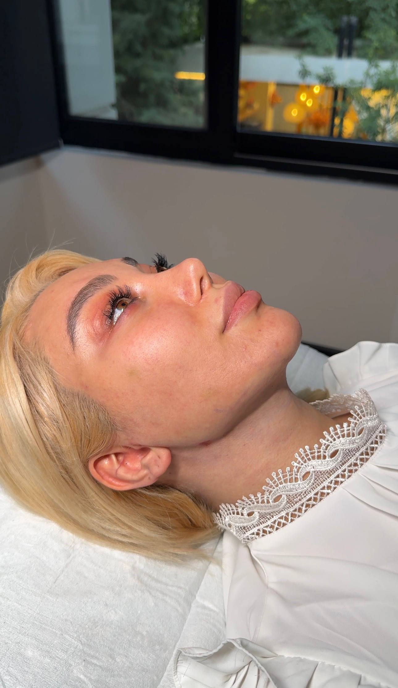 Double chin procedure