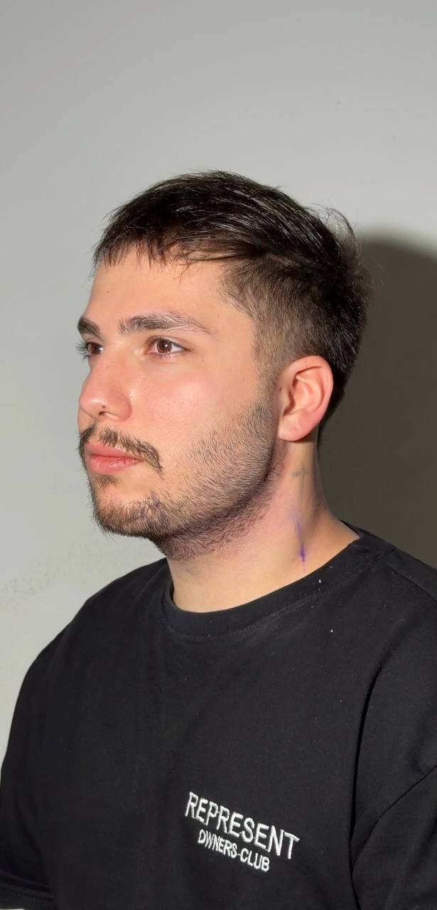 Double chin procedure