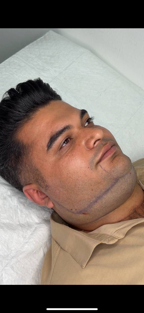 Double chin procedure