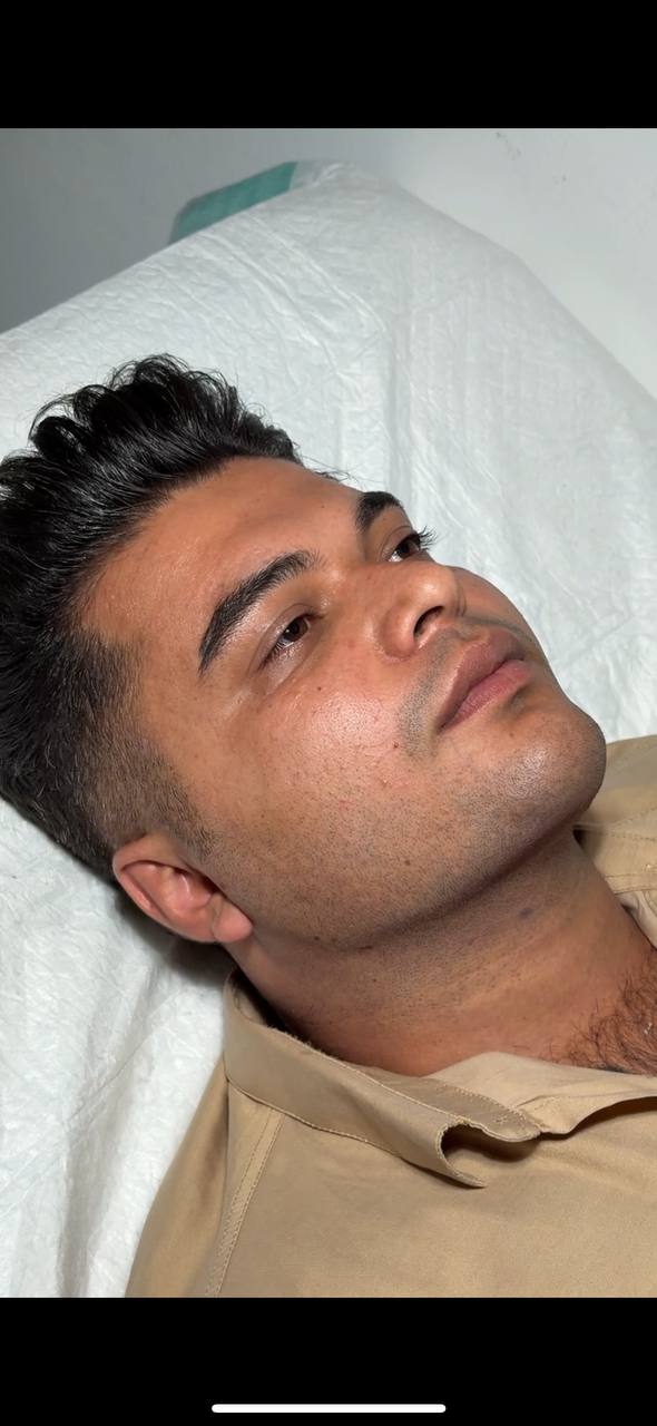 Double chin procedure