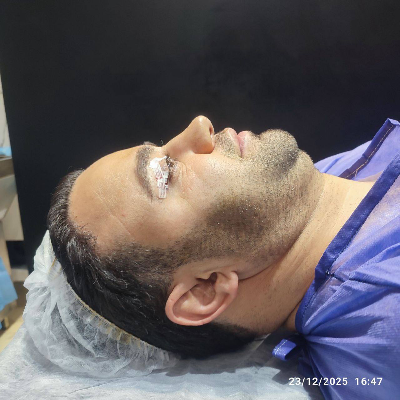 Double chin procedure