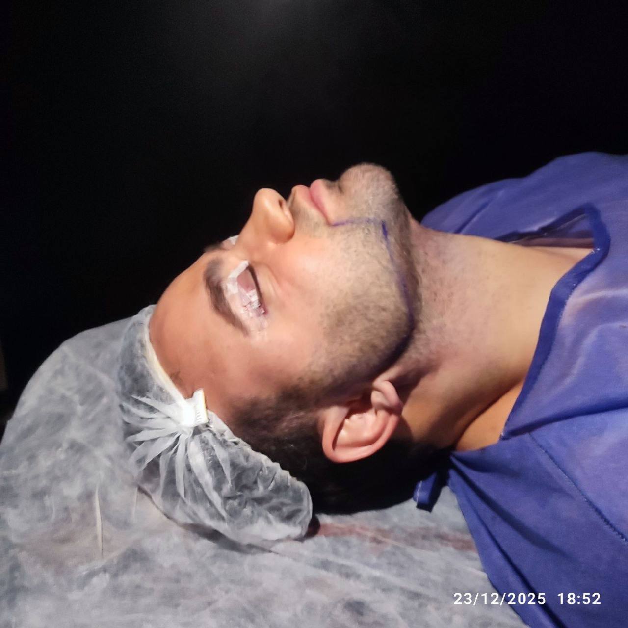 Double chin procedure