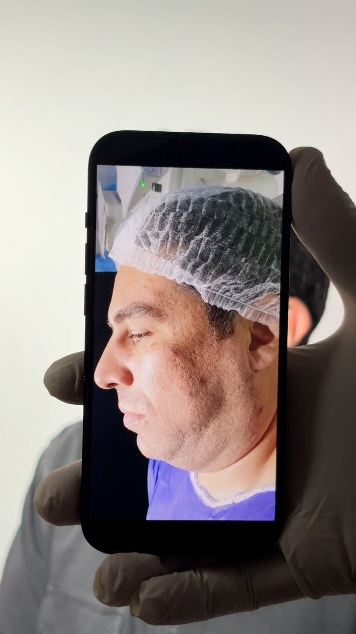 Double chin procedure