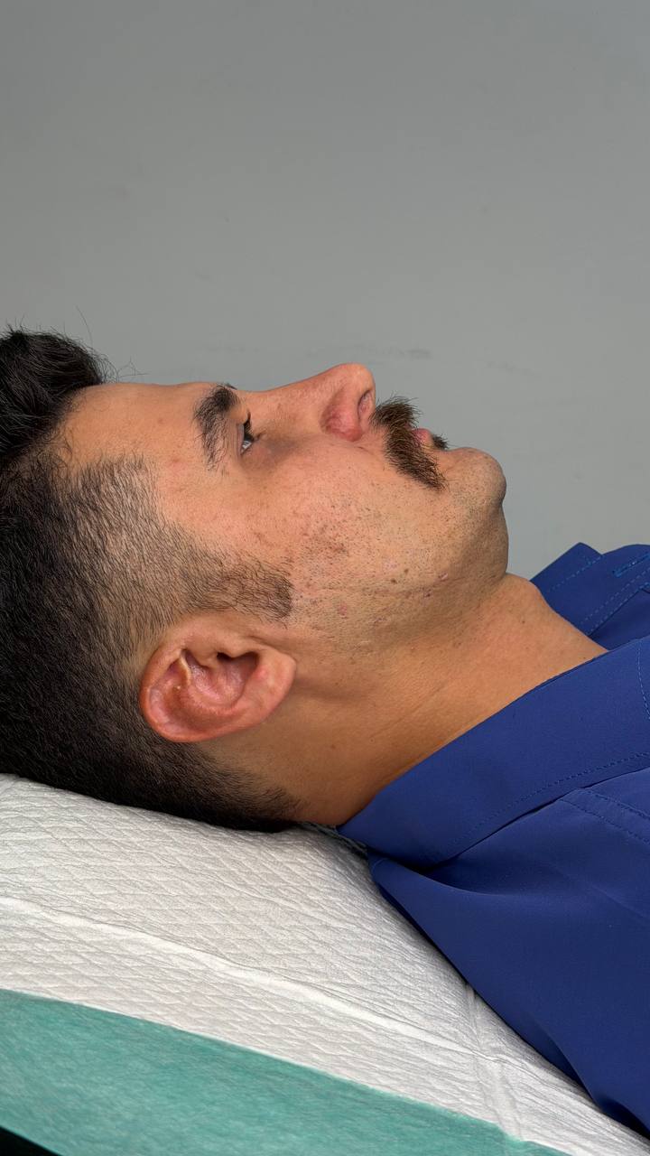 Double chin procedure