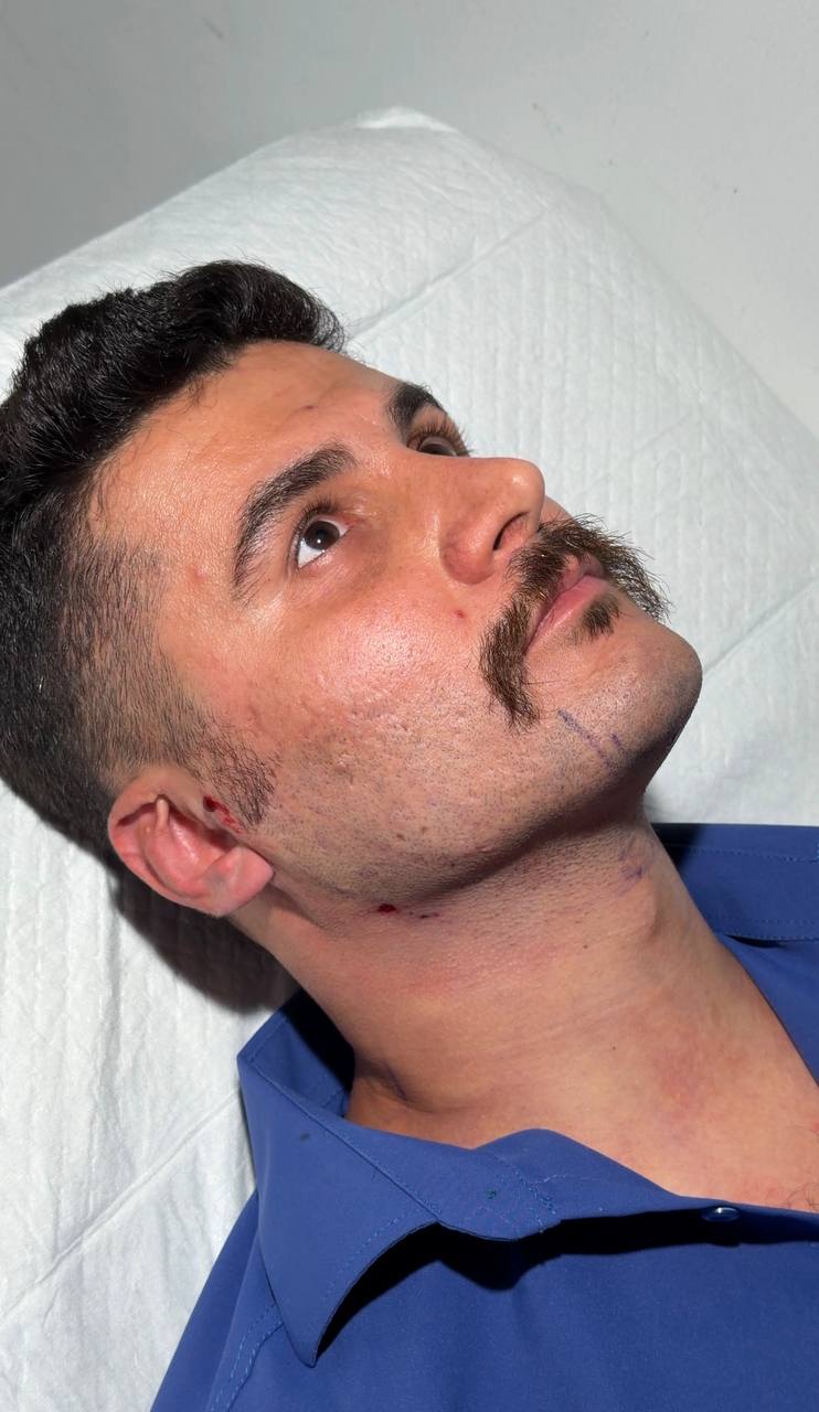 Double chin procedure