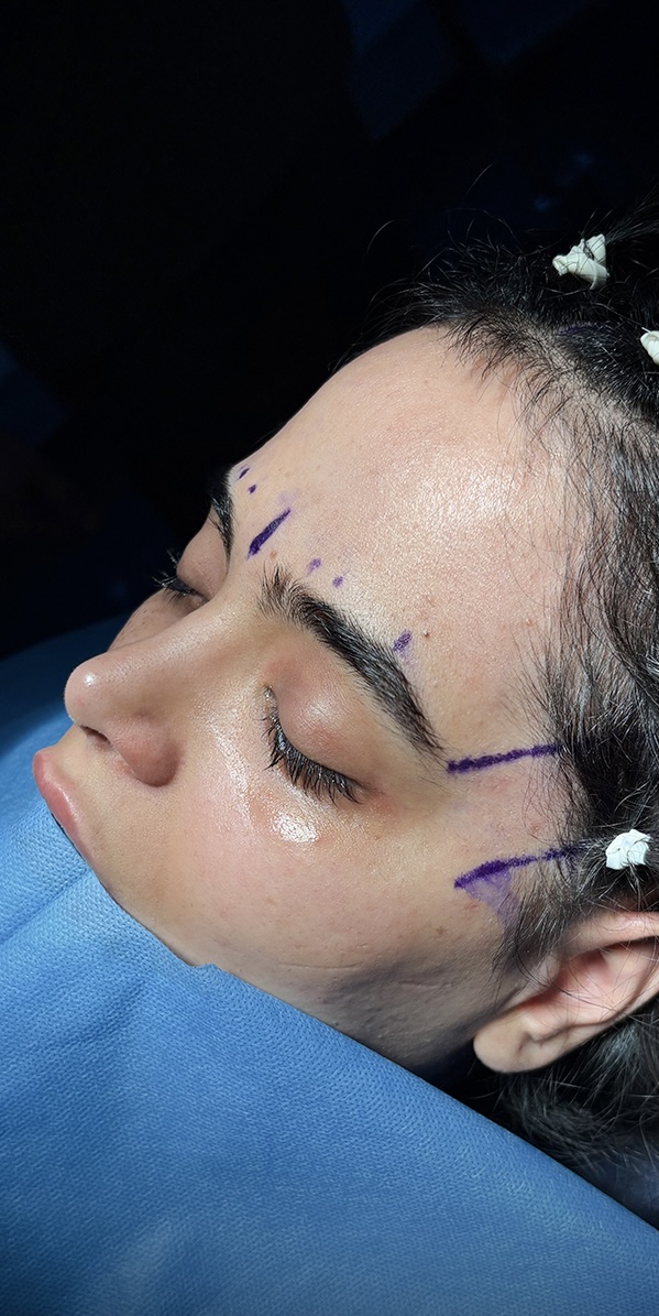 Before procedure