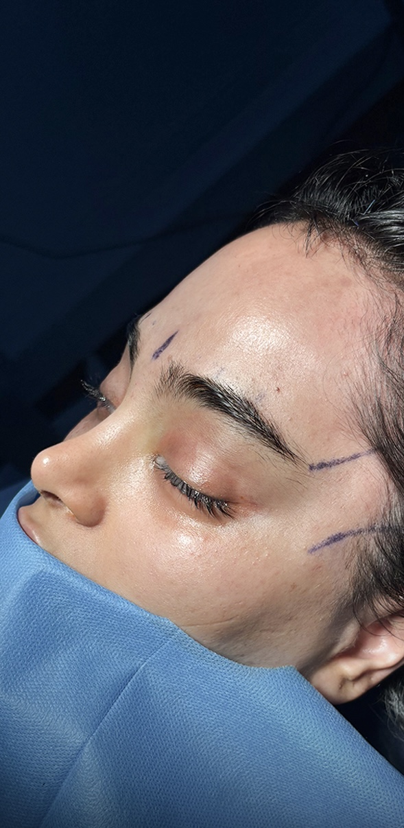 After procedure