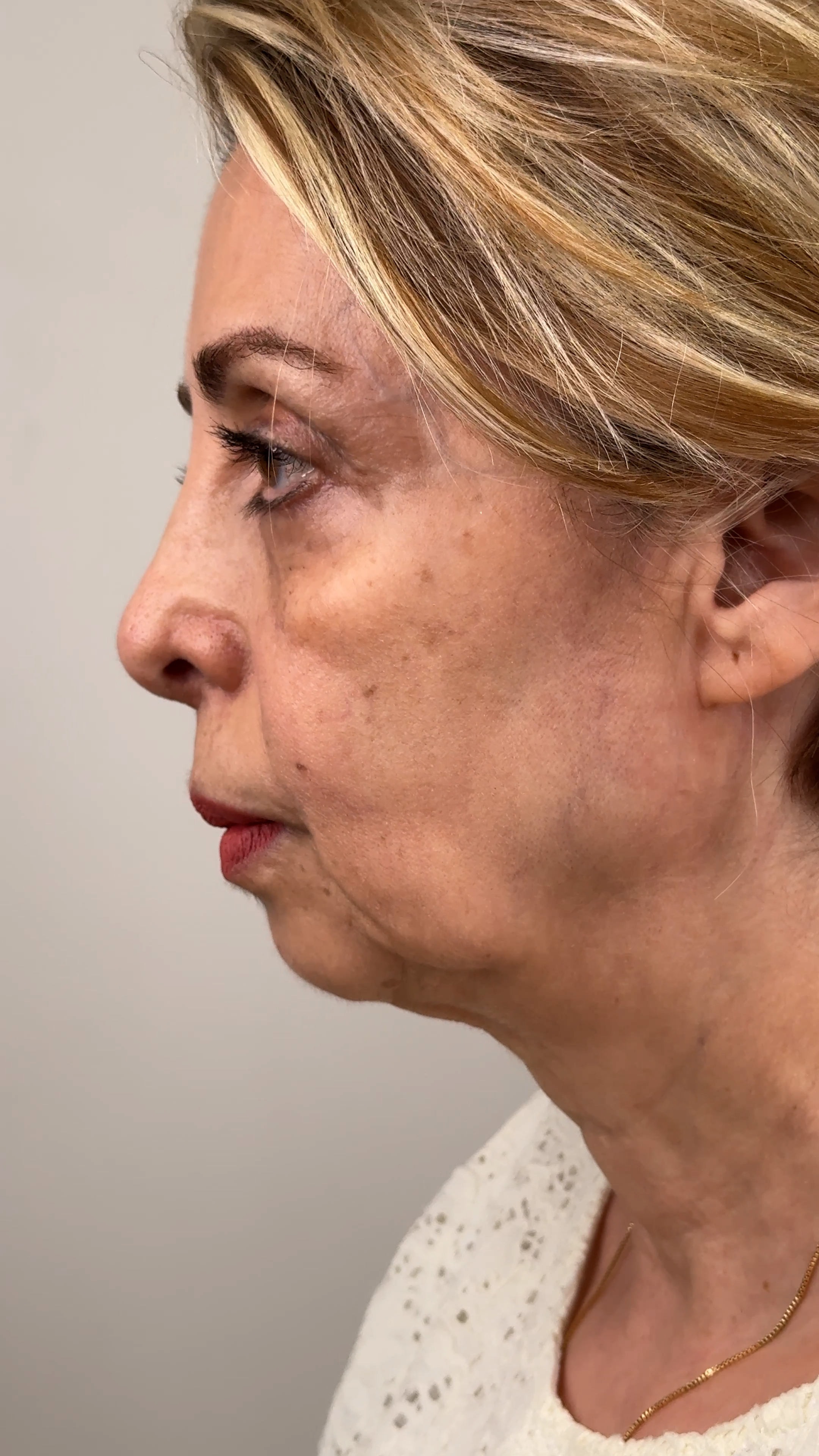 Before Procedure