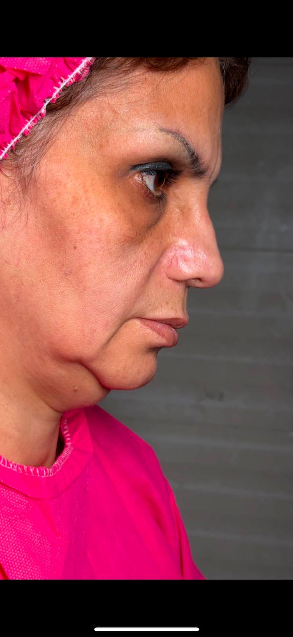 Before Procedure