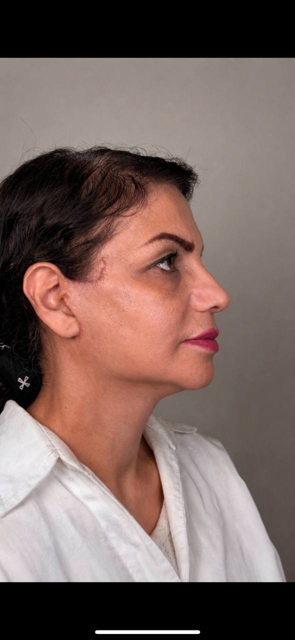 After Procedure