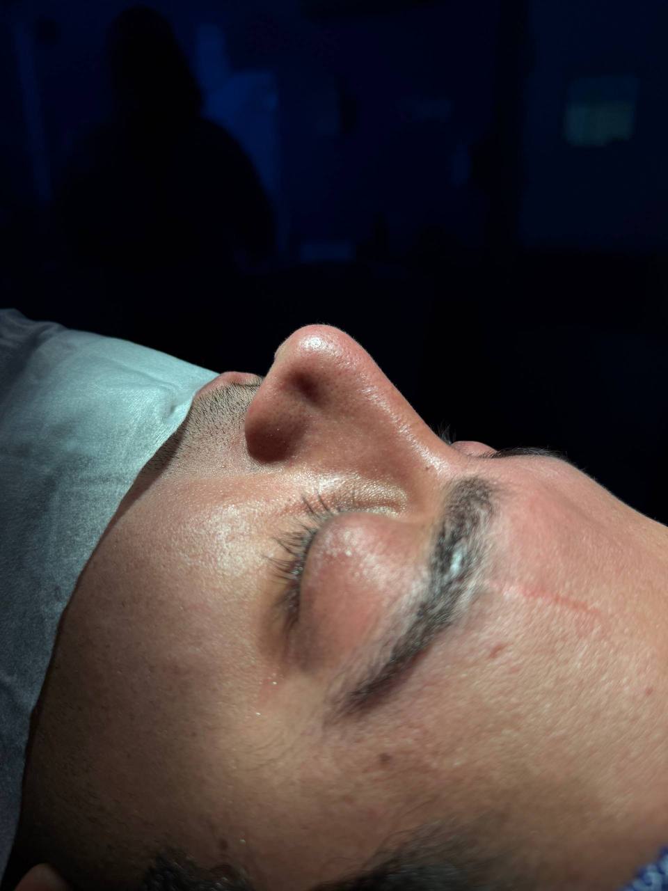 Before Procedure