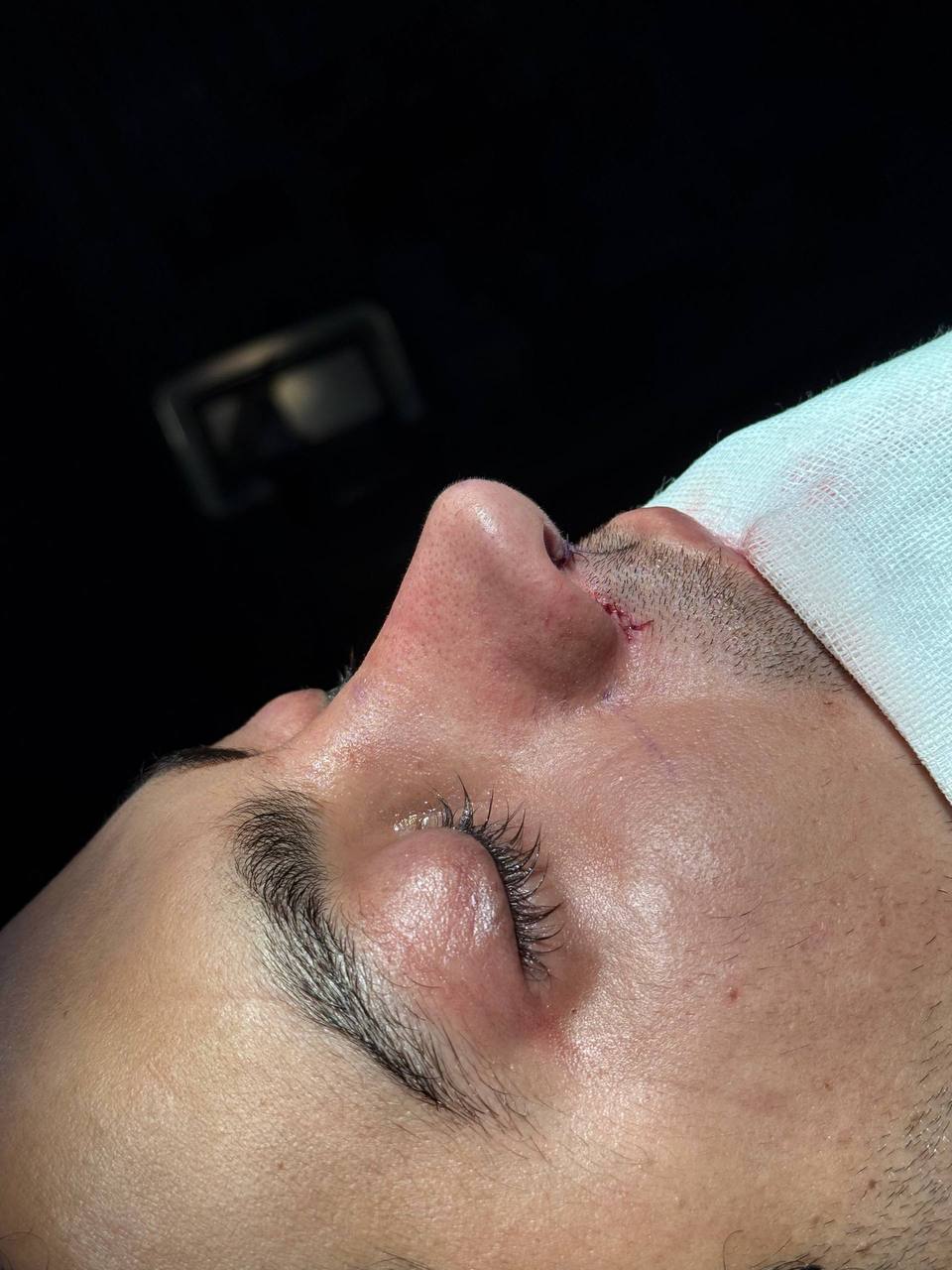 After Procedure