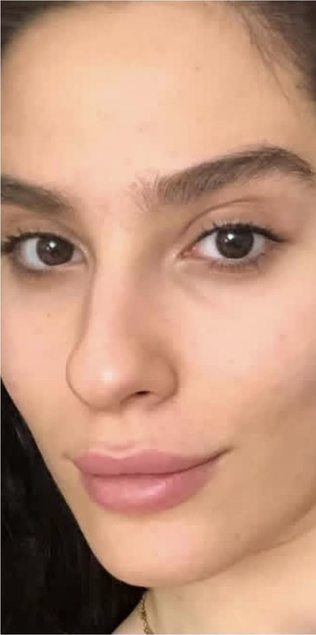 Before Procedure