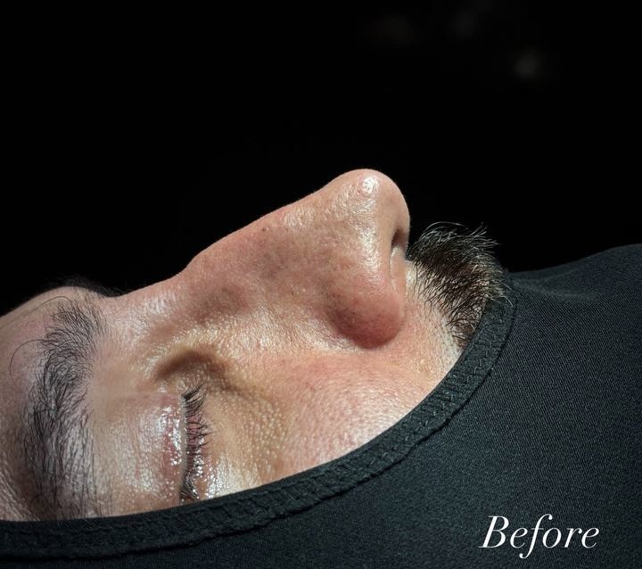 Before Procedure