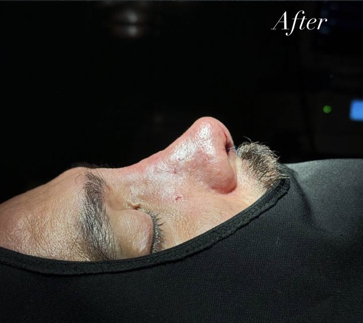 After Procedure