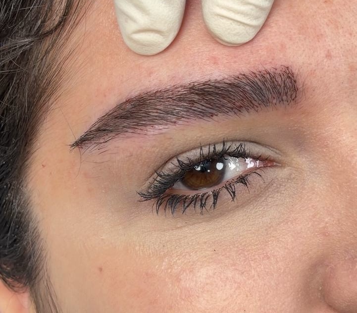 After Procedure