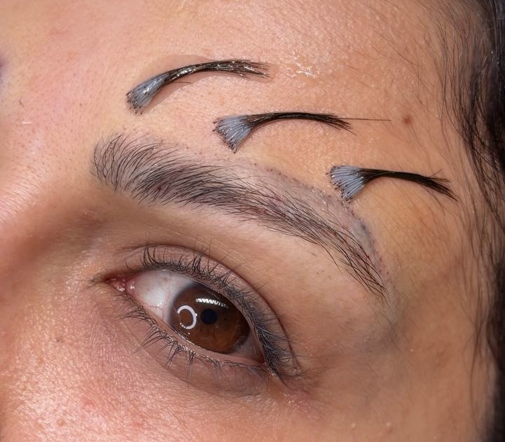 Before Procedure