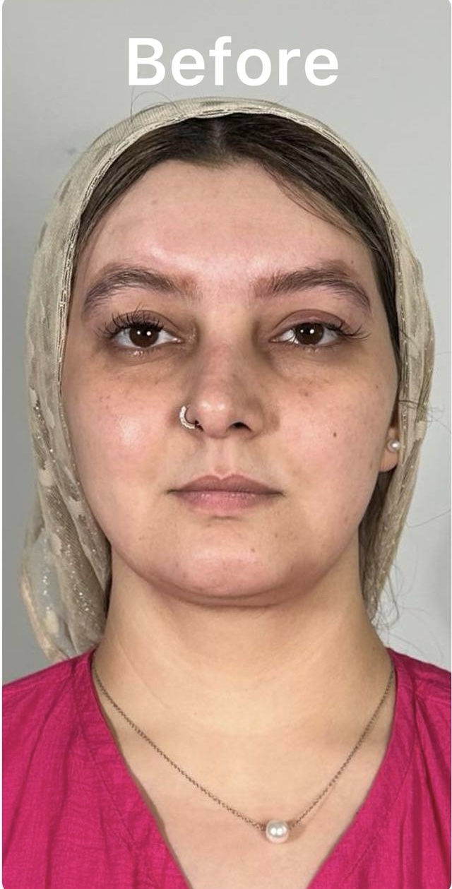 Before Procedure