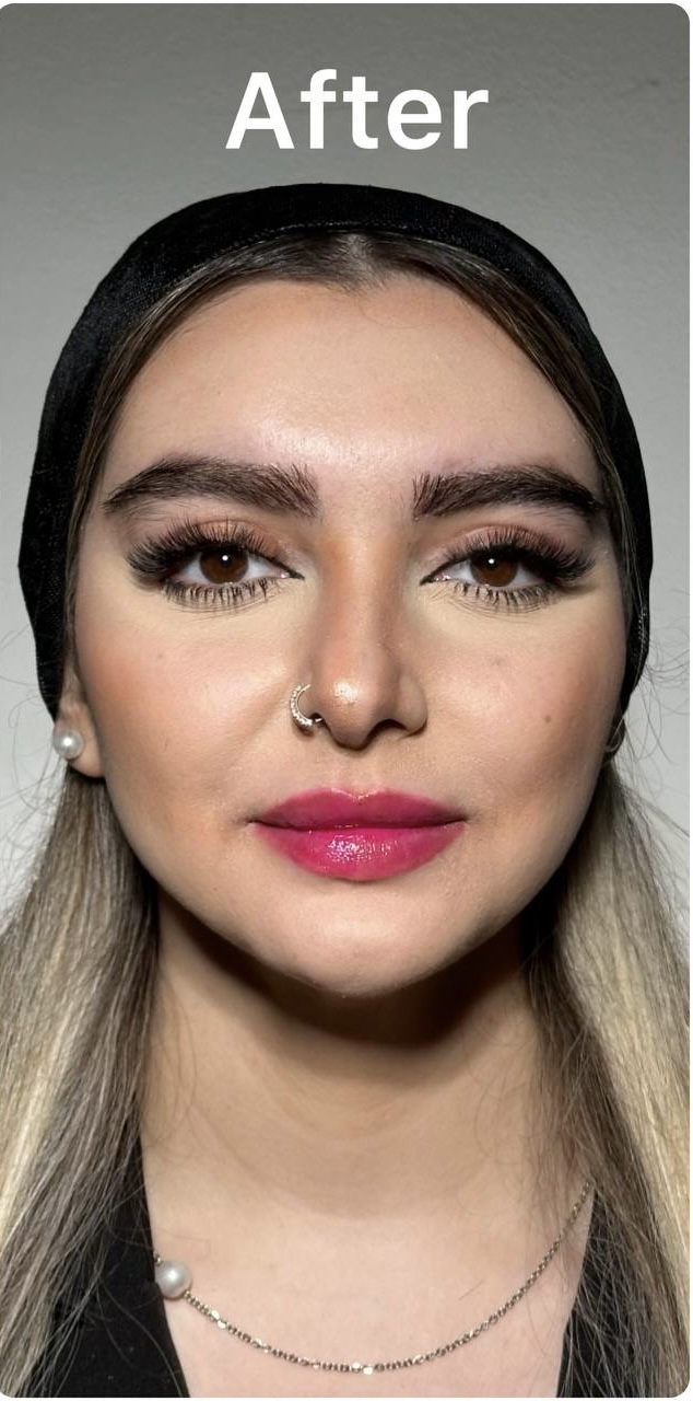 After Procedure