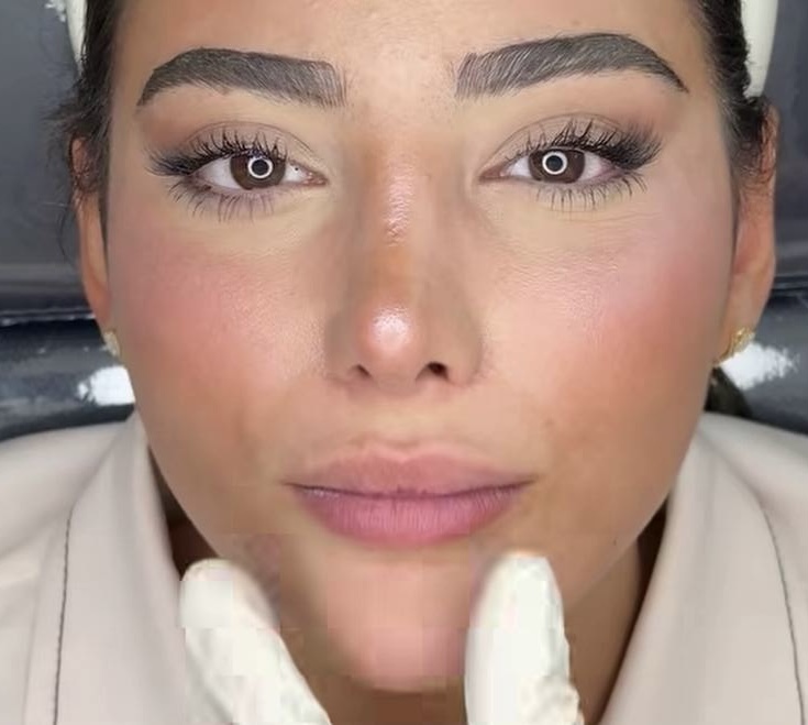 Before Procedure
