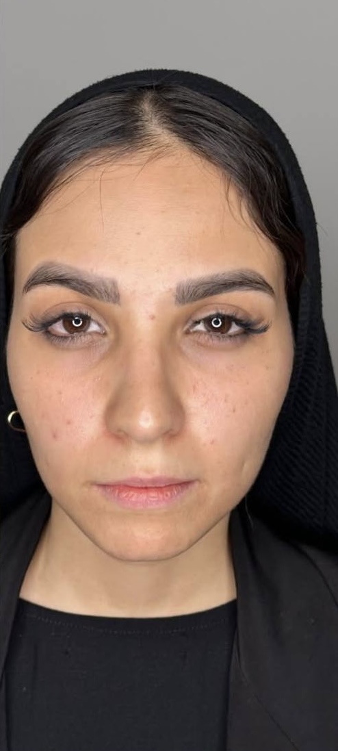 Before Procedure