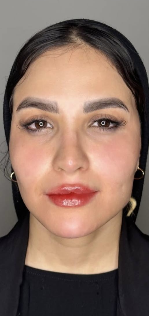 After Procedure