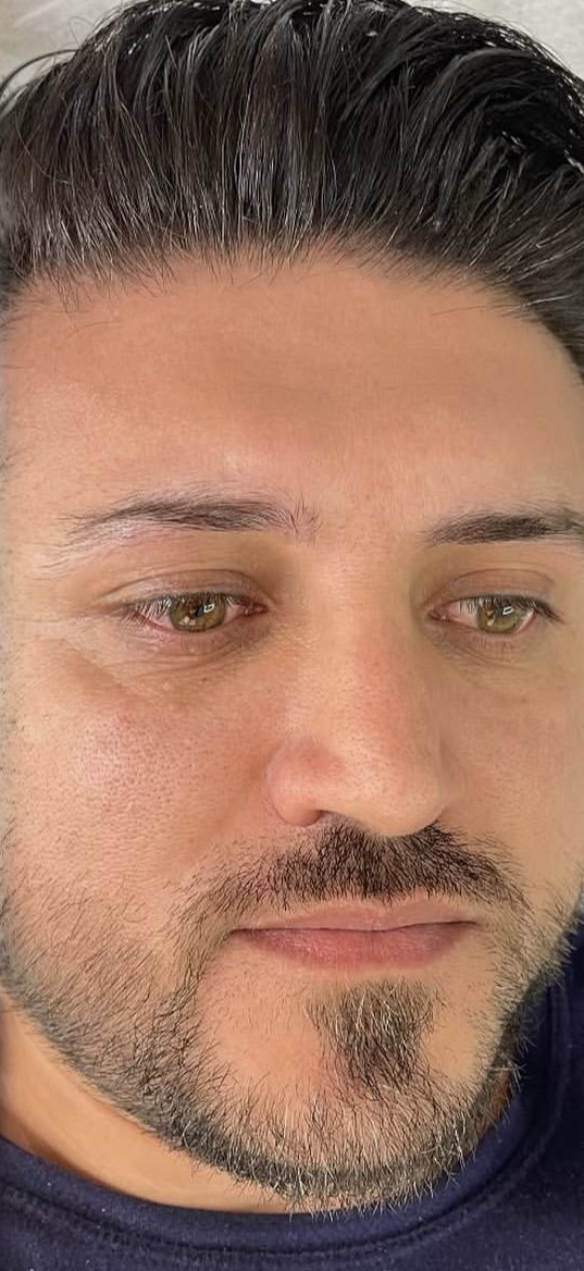 Before Procedure
