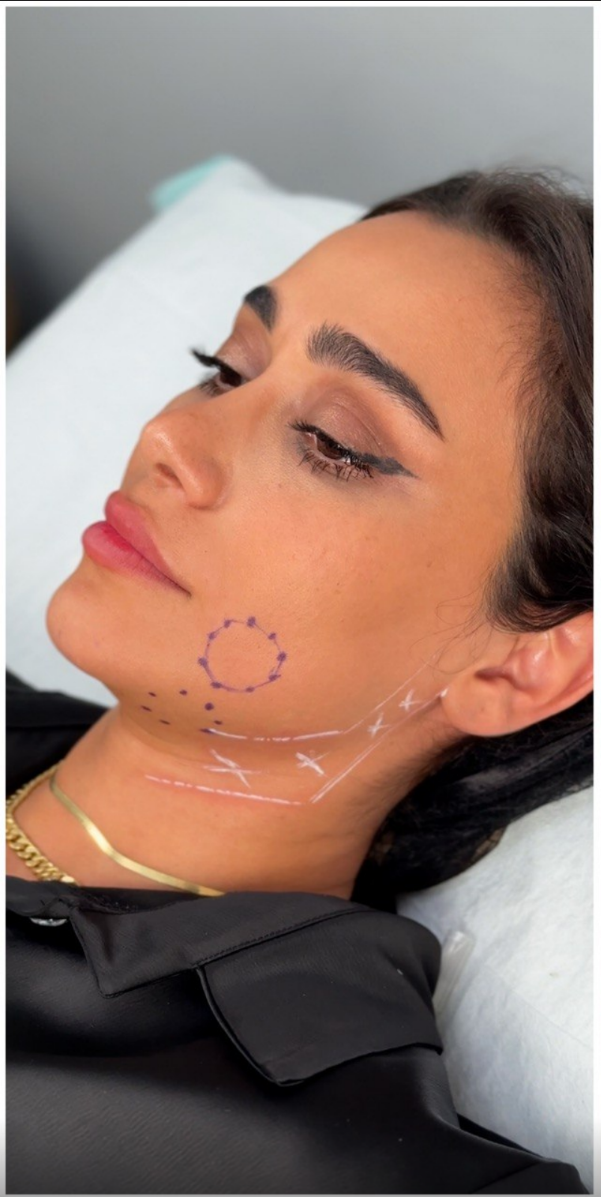 before procedure