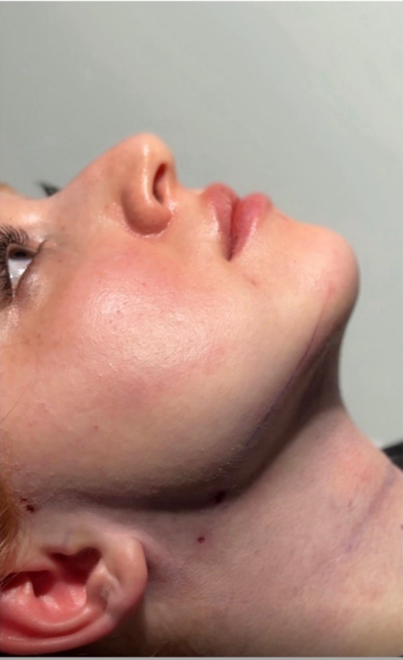 after procedure