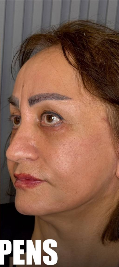 after procedure