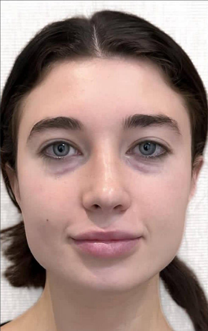 before procedure
