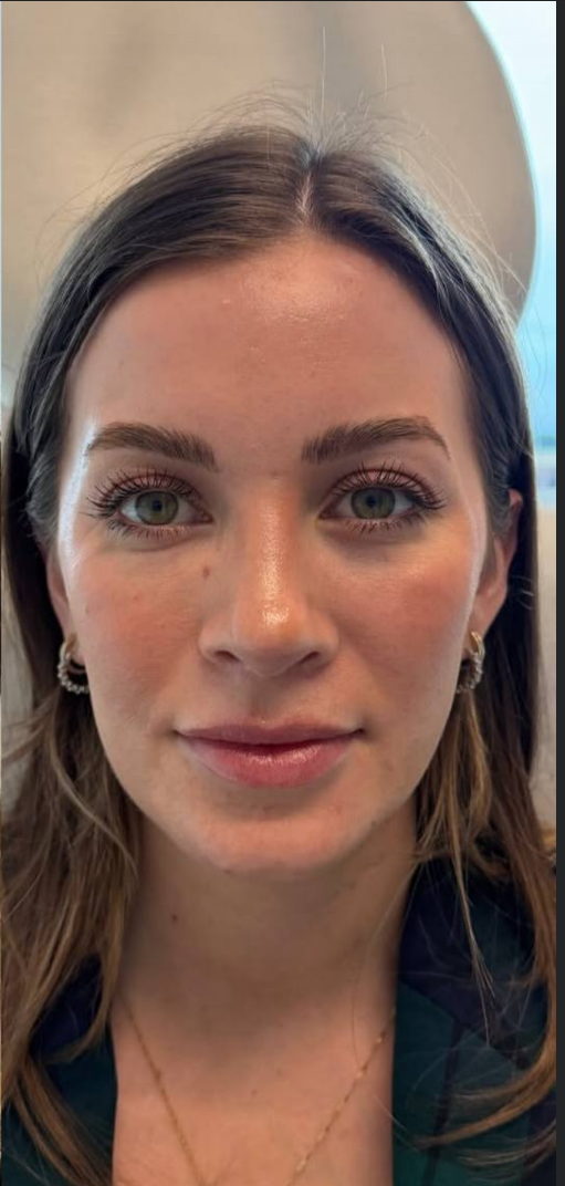 after procedure