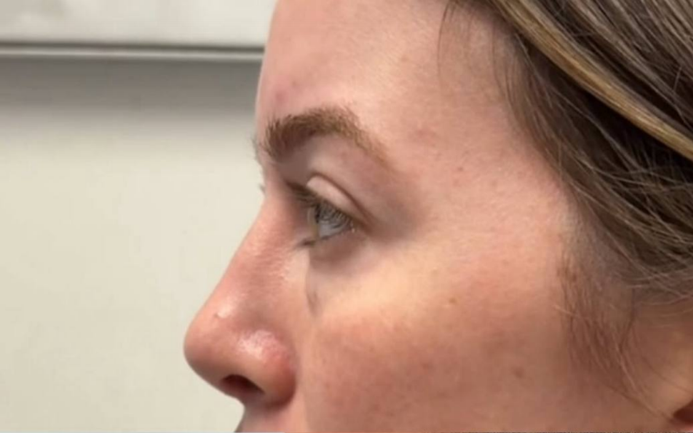 before procedure