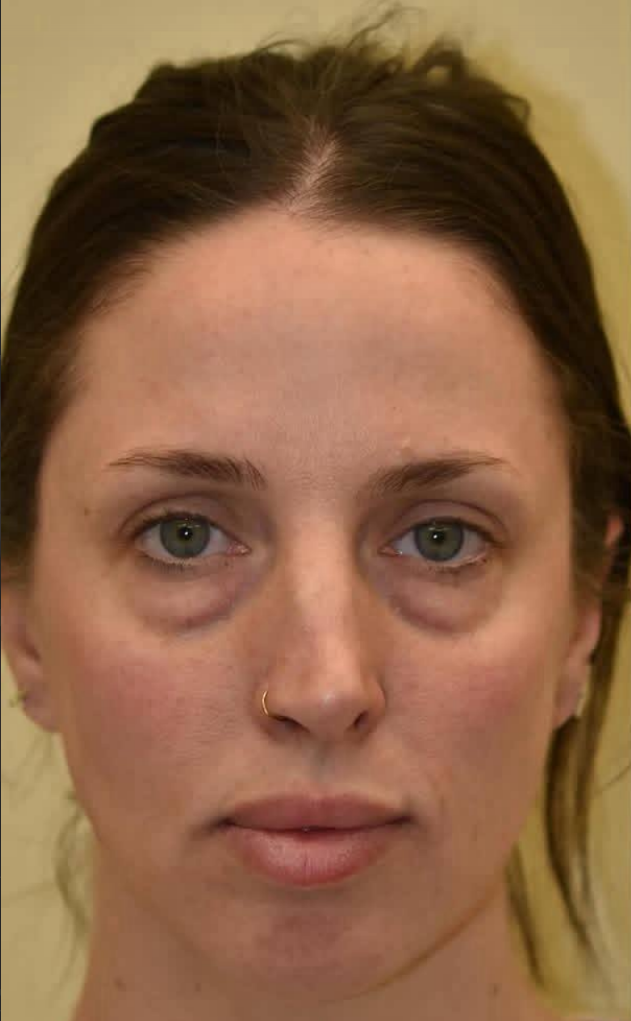 before procedure