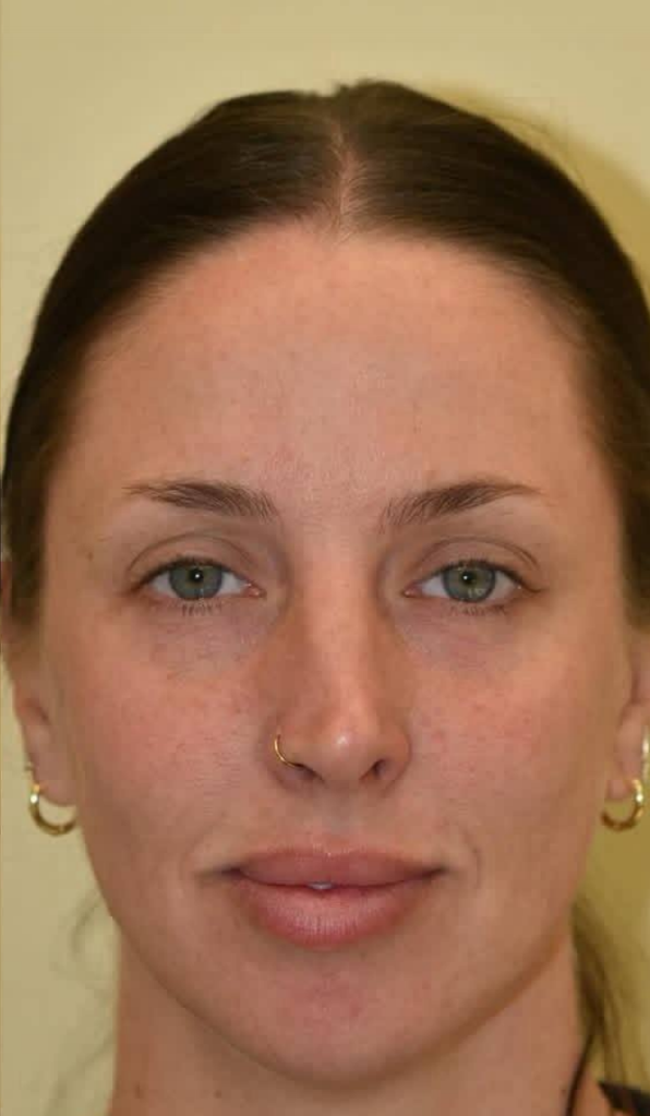 after procedure