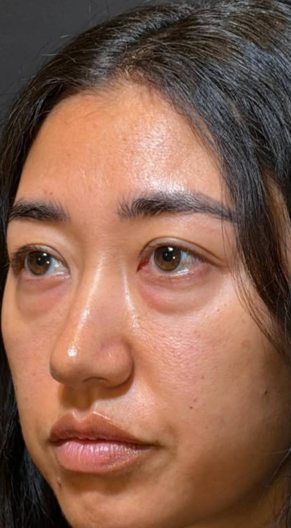 before procedure