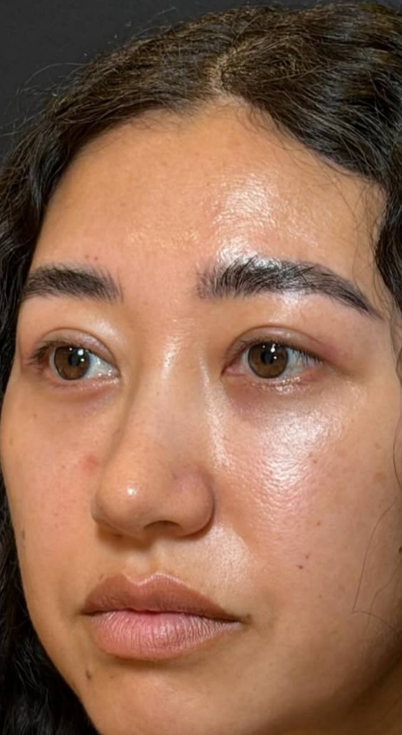 after procedure