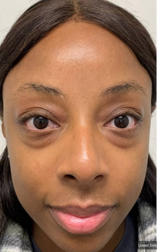 before procedure