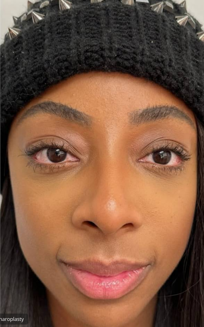 after procedure