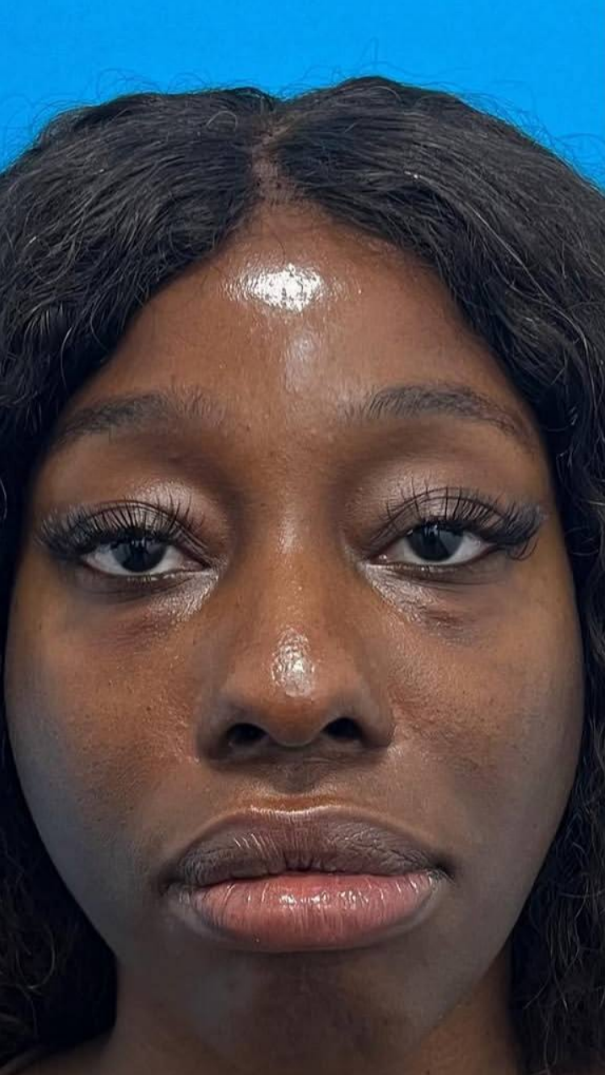 before procedure