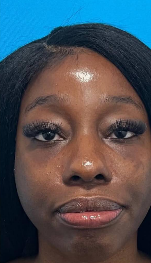 after procedure
