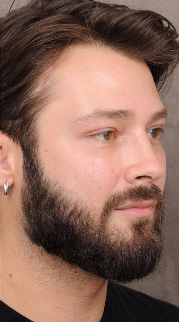 after procedure