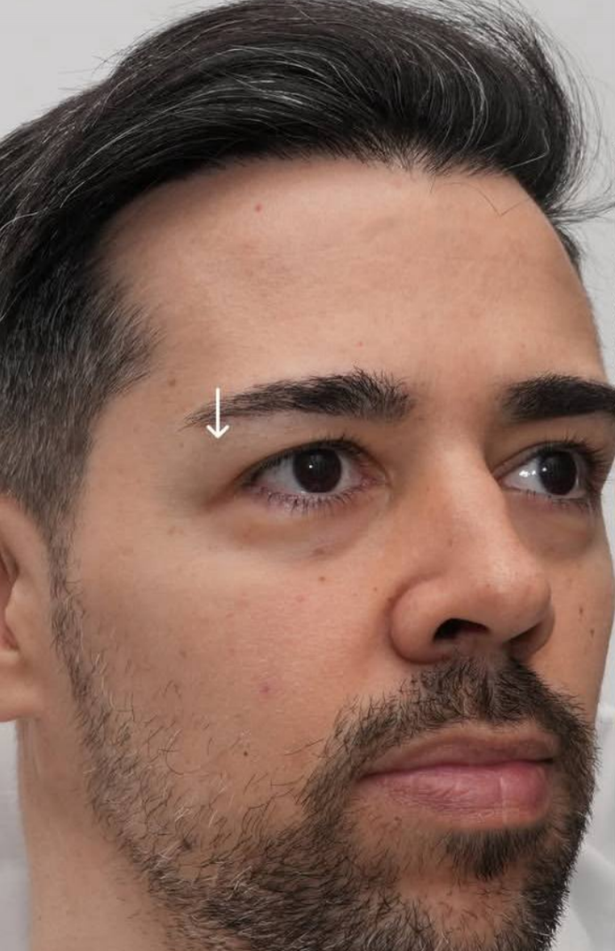 before procedure