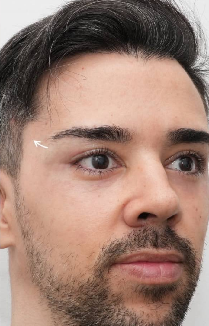 after procedure